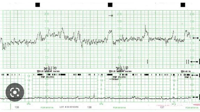 CTG monitoring explained in malayalam @mumandbabymalayalam смотреть онлайн