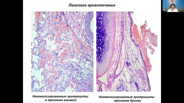 Лекция 4 Патологическая анатомия основных форм легочного туберкулеза 1 часть смотреть онлайн