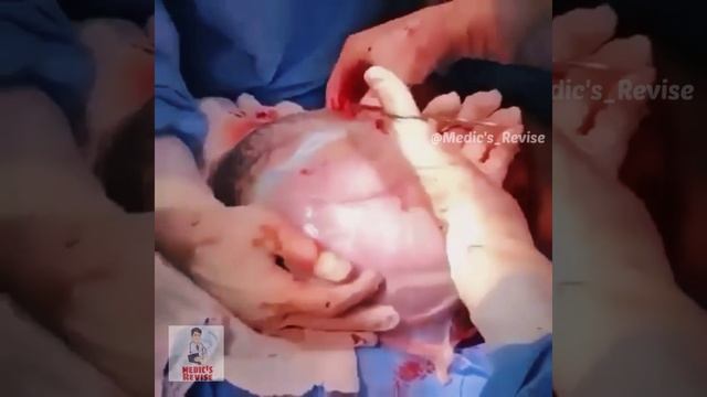 Amniotic Sac & Fluid Obstetrics #Mbbs #neetpg смотреть онлайн