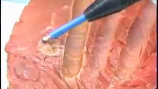 WAVETRONIC 5000 DIGITAL PARTE III (DIFERENTES FUNCIONES EN CIRUGÍA)