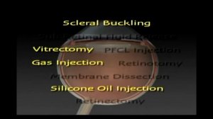 Операции при отслоении сетчатки
