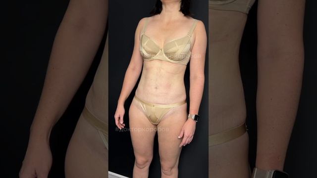 Преображение с помощью комплексной липосакции смотреть онлайн