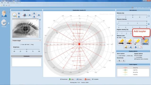 Tip Instructional – EyeSuite i9 Perimetry Performing a kinetic examination смотреть онлайн
