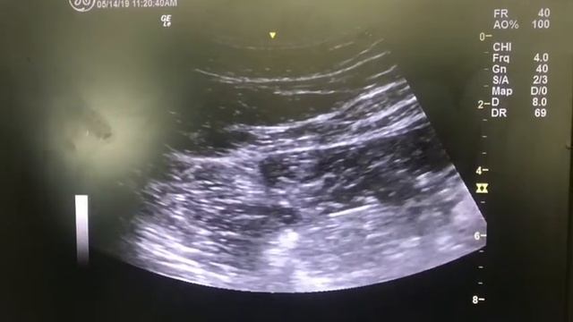 Quadratus Lumborum Block (QLB) posterior-intramuscular from supine position смотреть онлайн