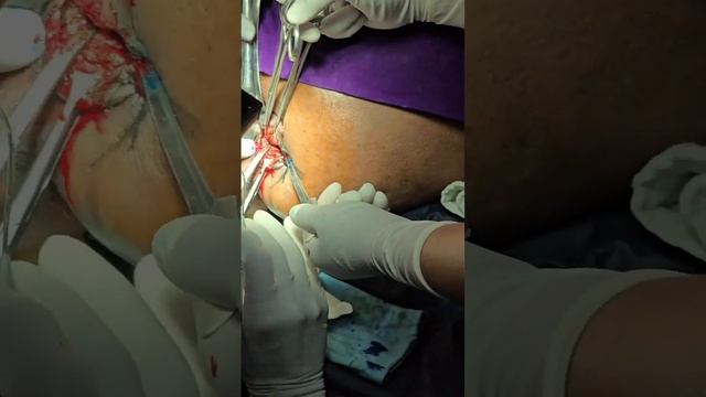 A HIGH ANAL FISTULA EXPLORATION BY RAIL ROAD METHOD смотреть онлайн