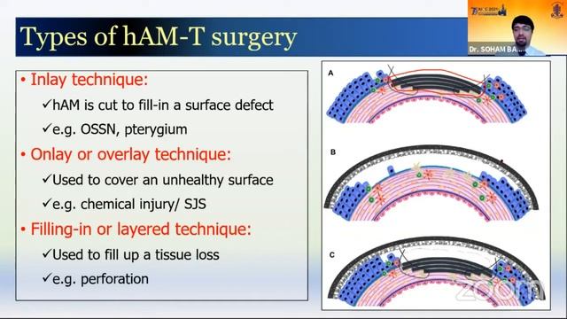 AIOC2021 - IC142 - Topic -Dr SOHAM BASAK 1 Introduction 2 How to prepare human amniotic memb.. смотреть онлайн