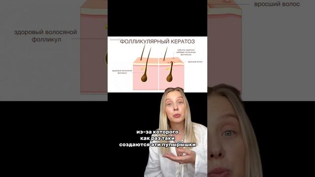 Что делать с ПУПЫРЫШКАМИ на коже? Артикулы Пенка- 139625239 ,Крем для ног- 124736678 #ноги #уход смотреть онлайн