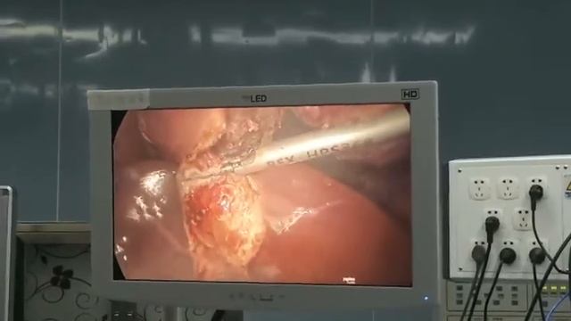 Ultrasound Hemostatic Knife / Ultrasonic Scalpel Clinical Video - YSUSG300 смотреть онлайн