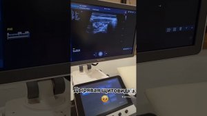 Аутоиммунный тиреоидит. дырявая щитовидка.