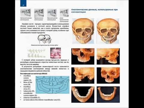Pataraya Immediate Implantation смотреть онлайн