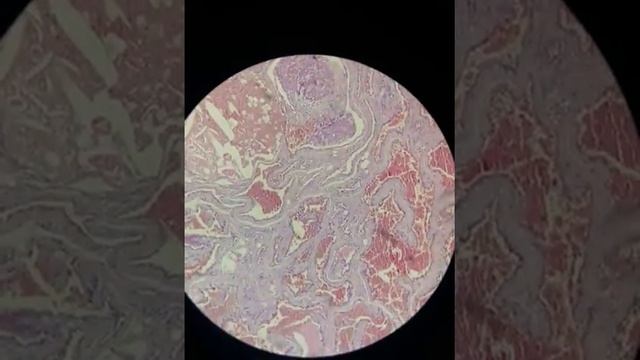 40 Cavernous hemangioma смотреть онлайн