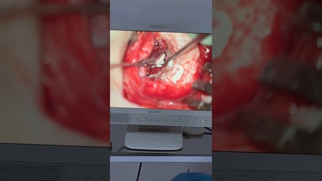 👂 Тимпанопластика - пластика слуховых косточек Восстановление слуха #medas #ташкент #хирург смотреть онлайн
