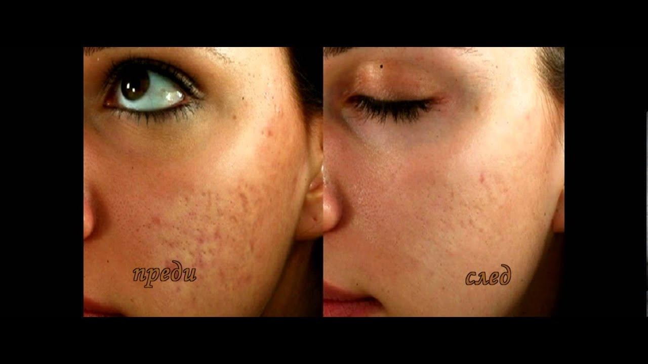 Derma Moderno btv Valianova oct2013 смотреть онлайн