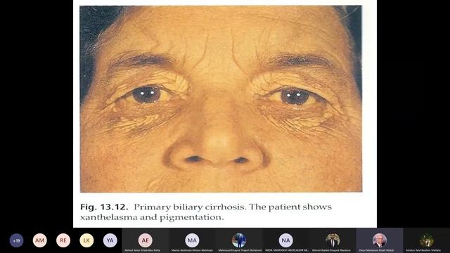 Value of Symptomatology and investigations of hepatic diseases + Jaundice. смотреть онлайн