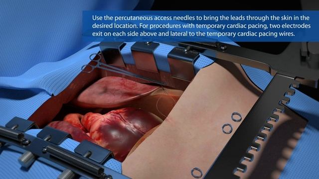 TransAeris Diaphragm Pacing System Implant Procedure смотреть онлайн