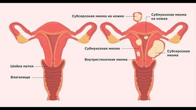 БАЧАДОН МИОМАСИ смотреть онлайн