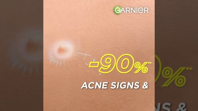 NO ACNE TO STOP YOU with NEW Garnier Anti Acne Serum! смотреть онлайн
