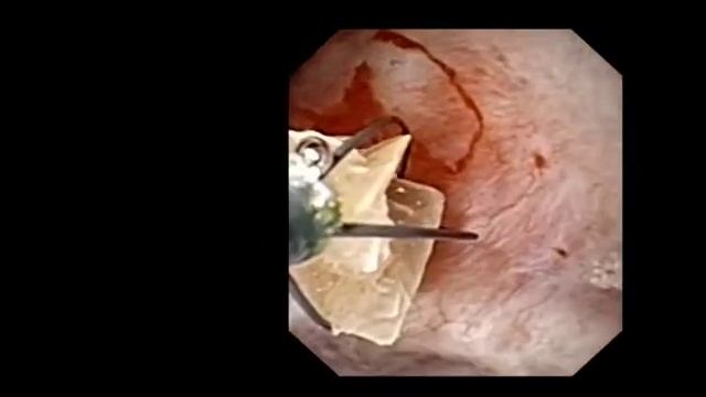 3 2 2 1 Calcium oxalate dihydrate grasped with basket смотреть онлайн