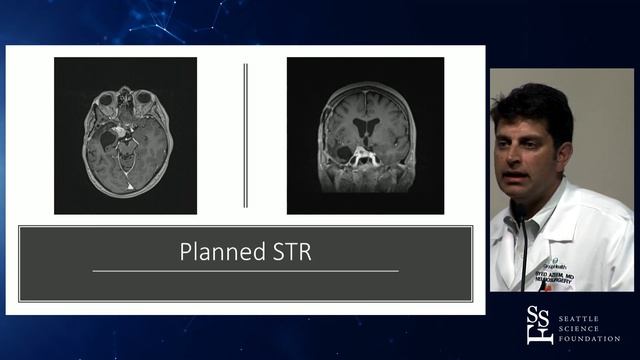 Meningioma: An unmet clinical need - Syed S. Azeem, MD смотреть онлайн