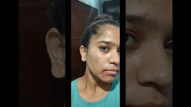 25 days complete tretinoin cream 0.025% #tretinoincream #face #tretinoin смотреть онлайн