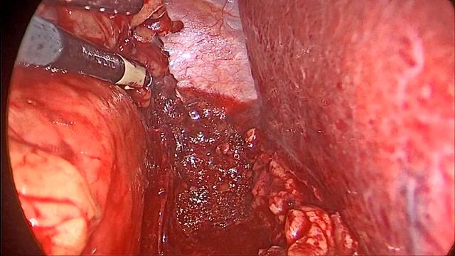 2022 10 18 Laparoscopic Right Nephrectomy / Лапароскопическая нефрэктомия справа смотреть онлайн