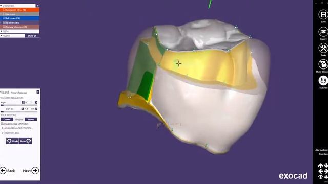 Exocad Quick Guide  Advanced Telescopic Crown Design With Cutback