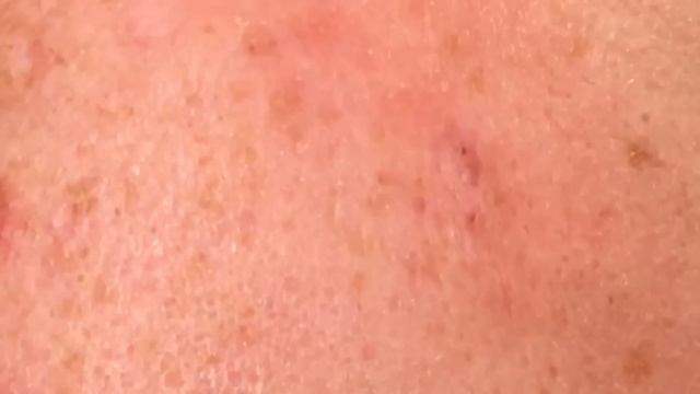Iris Blackhead Extractions