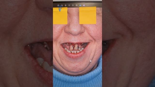 Разбор случая с удалением 19 зубов. Имплантация зубов. смотреть онлайн