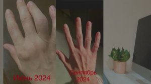 Ревматоидный артрит -Излечим! Часть 1. Смотрите продолжение в профиле. Часть 2. Интервью