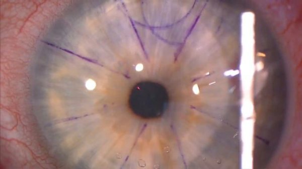 Moria's OUP SBK: Mechanical Microkeratome (in HD)