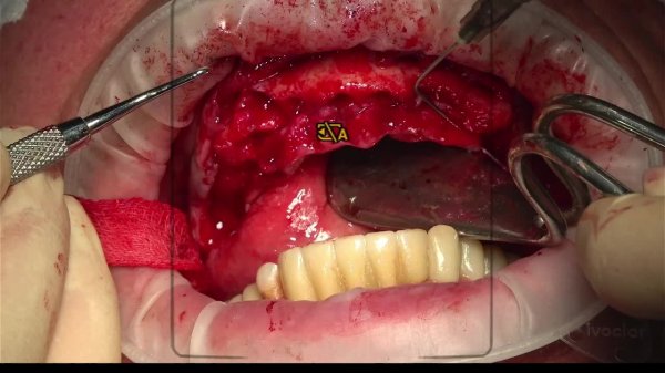 операция MAXILLA FOR ALL