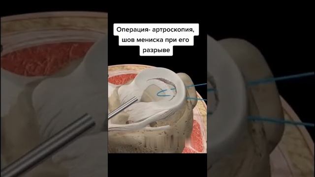 шов мениска операция на коленном суставе смотреть онлайн