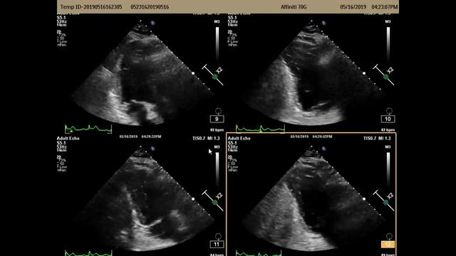 Echocardiography Research: If You're Not Using Speckle Tracking, You're Missing Out!(AEUS Sponsored смотреть онлайн