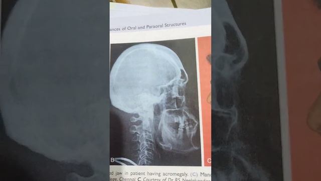 Identify the anomaly/ Oral Pathology #dental #neetmds #mds #bds #oralpathology смотреть онлайн