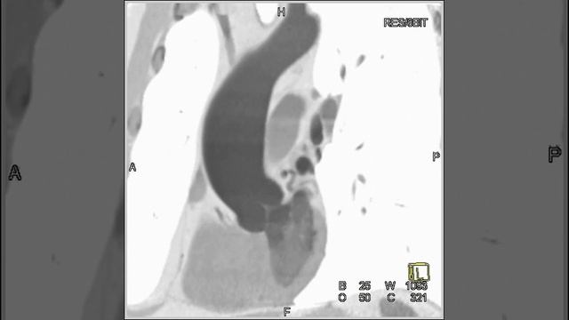 Cardiac: Dilated ascending aorta (2 of 3) смотреть онлайн