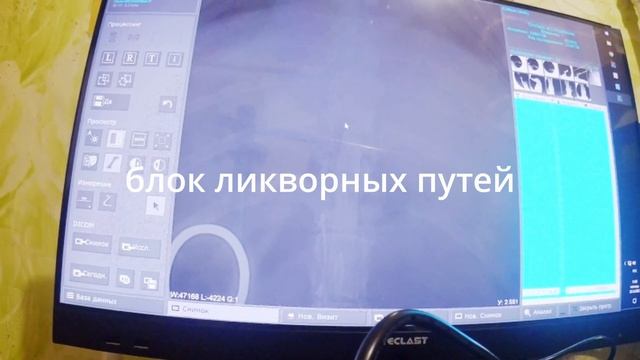 Миелография и гемиламинэктомия Мариуполь смотреть онлайн