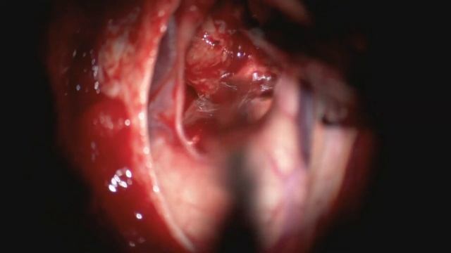 Left frontal cancer metastasis © Andrey Gavrjushin, M. D., Ph. D. смотреть онлайн