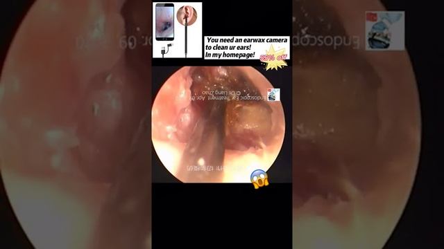 Best Ear Wax Removal & Extraction with Vacuum Remover 真空リムーバーによるにきびの除去と抽出 123 смотреть онлайн