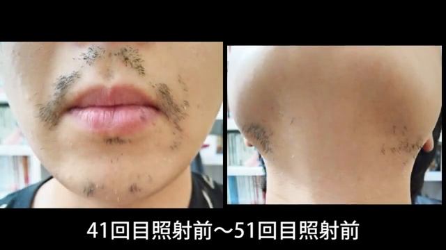 光脱毛器を髭に100回照射したらどうなる？4年以上かけて髭脱毛の効果を検証した結果・・・【フィリップス・ルメア使用】 смотреть онлайн
