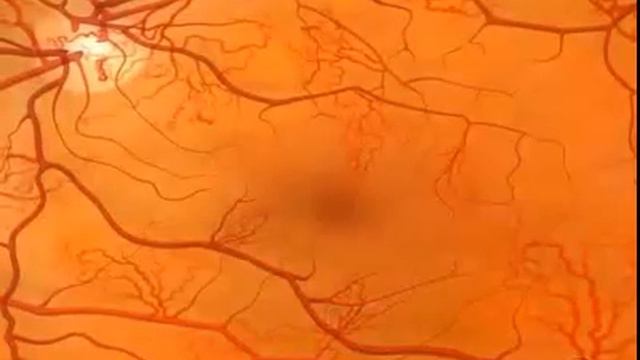 Пролиферативная диабетическая ретинопатия смотреть онлайн