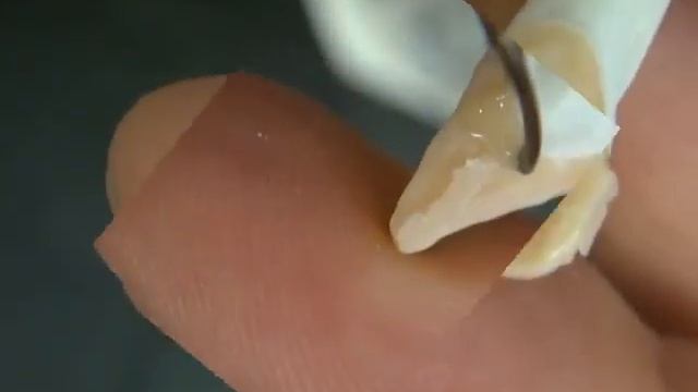 WAX UP CENTRAL INCISOR by Mohamed Alaeddin, Harvard University смотреть онлайн