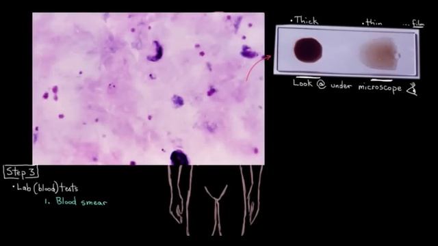 Diagnosing malaria | Infectious diseases | NCLEX-RN | Khan Academy смотреть онлайн