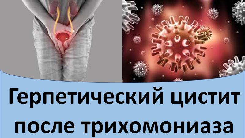Герпетический цистит после трихомониаза смотреть онлайн