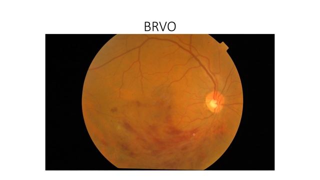 Qualitative analysis of OCT macula: OCT interpretation for macular pathologies смотреть онлайн