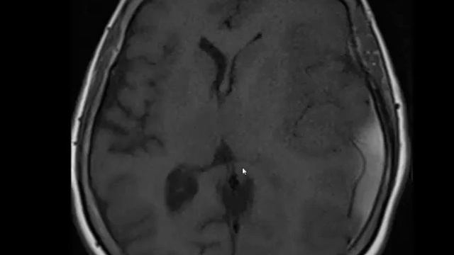 GEÇ SUBAKUT SUBDURAL HEMATOM MR смотреть онлайн