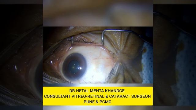 INTRAVITREAL INJECTION IN PHAKIC EYE