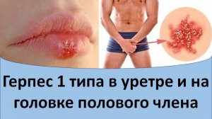 Герпес 1 типа в уретре и на головке полового члена