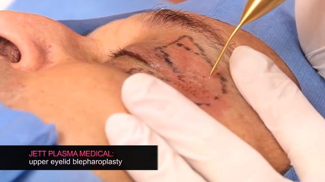 Jett Plasma Medical - Blepharoplasty (noninvasive) смотреть онлайн