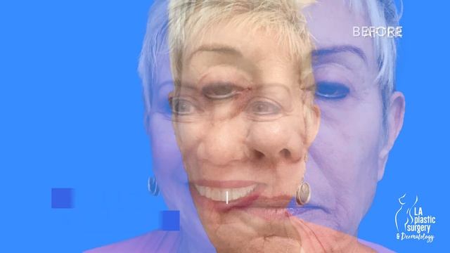 Renuvion Plasma Laser Before and After - PLASMA LYFT FACELIFT By Dr. Lacerna смотреть онлайн