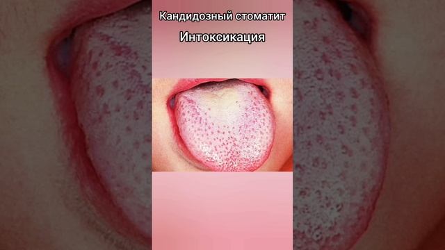 Диагностика по языку. О чем говорит налет на языке смотреть онлайн